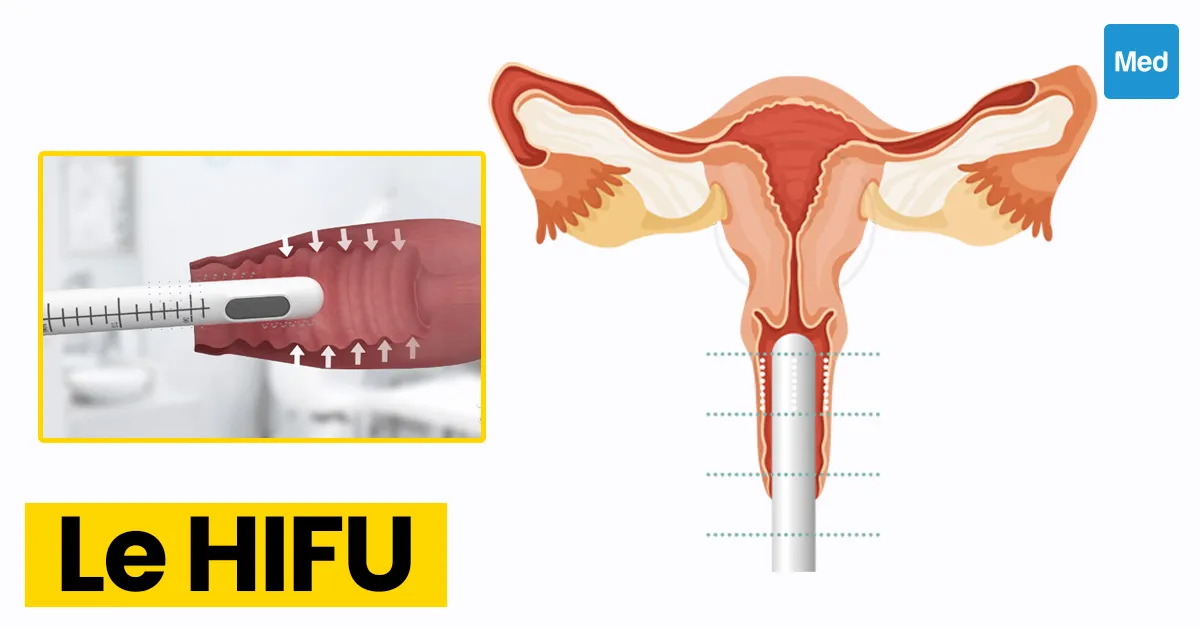 HIFU gynécologique : une nouvelle technique prometteuse